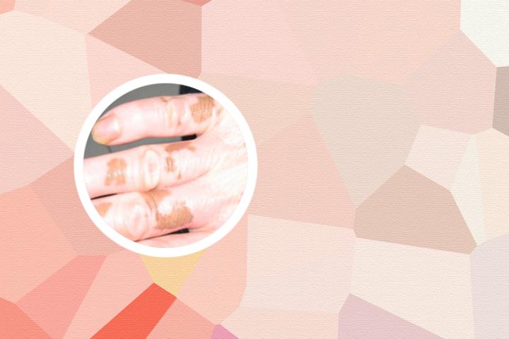 襄阳哪个医院治疗白癜风