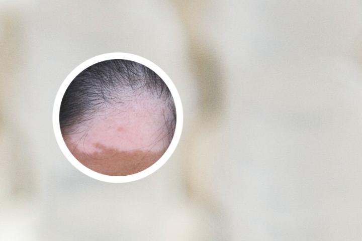 贵阳白癜风药膏去黑头测评