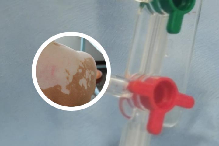 白癜风维生素e涂脸功效