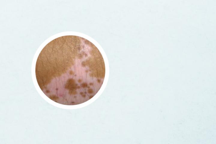蜂巢加香油能治白癜风吗