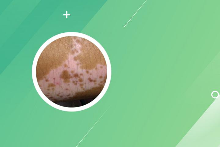 白癜风可吃椰子肉吗