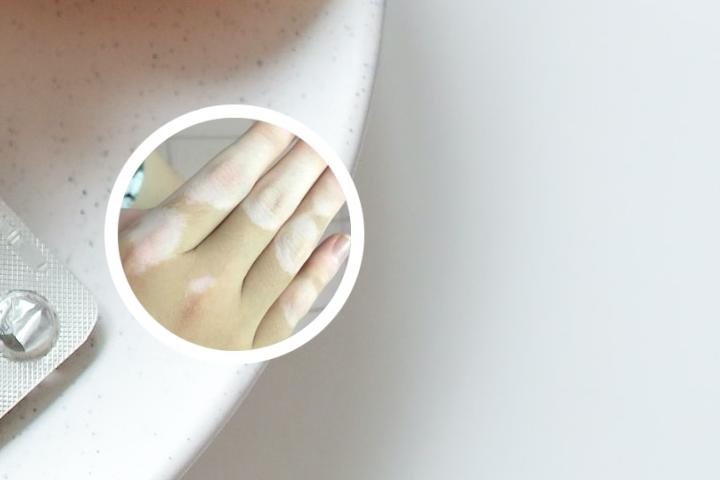 患了白癜风可以吃南瓜吗
