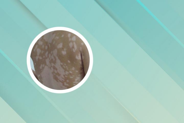 白癜风愈后能停药吗