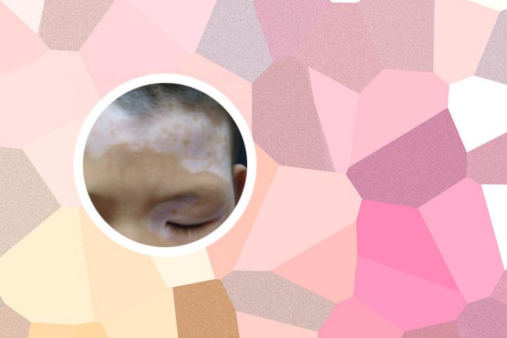 白癜风能喝洋葱吗