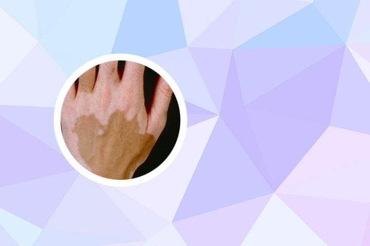 孙秋宁看白癜风可以吗