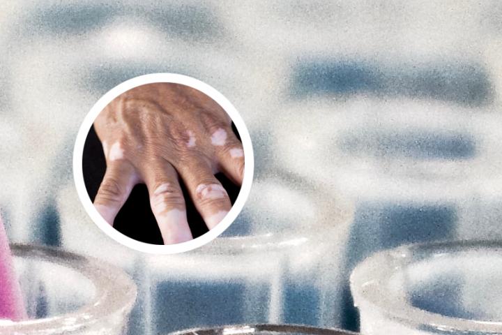 白癜风光疗变红多久能变黑
