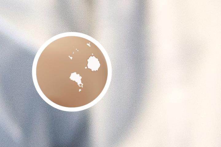 侧柏治白癜风吗