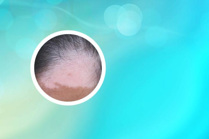 白癜风中医辨治
