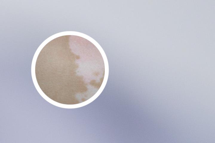 栗子白癜风能吃吗