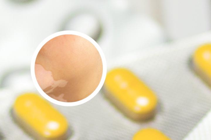 白癜风中药香囊博客