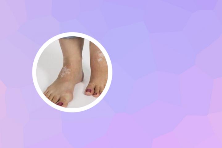 白癜风眉骨