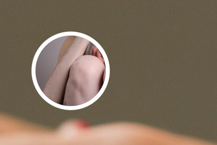白癜风可以吃桑子吗