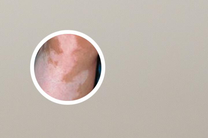 白癜风可以吃玉米火腿肠吗