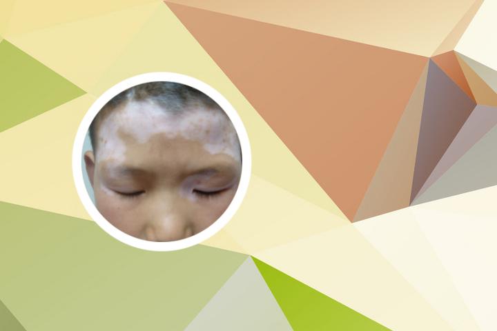 白癜风可以吃血块吗