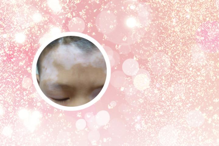 白癜风治疗哪里最好