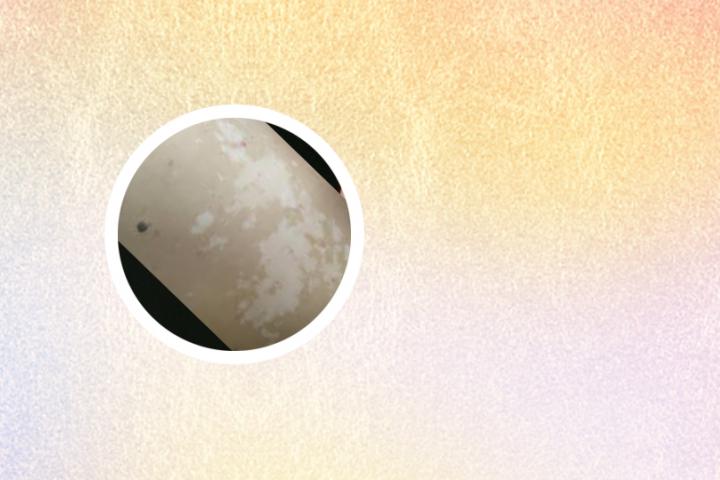 白癜风维生素e