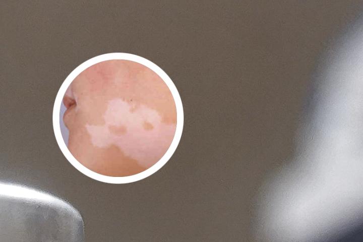 白癜风汗毛没有了