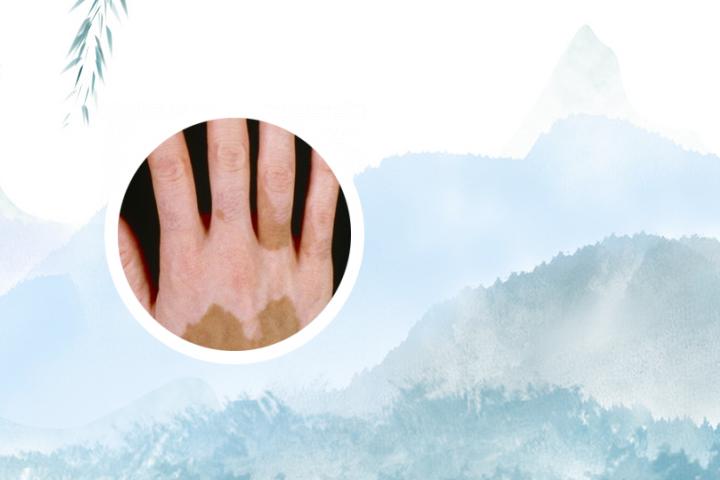 西安中医医院治疗白癜风