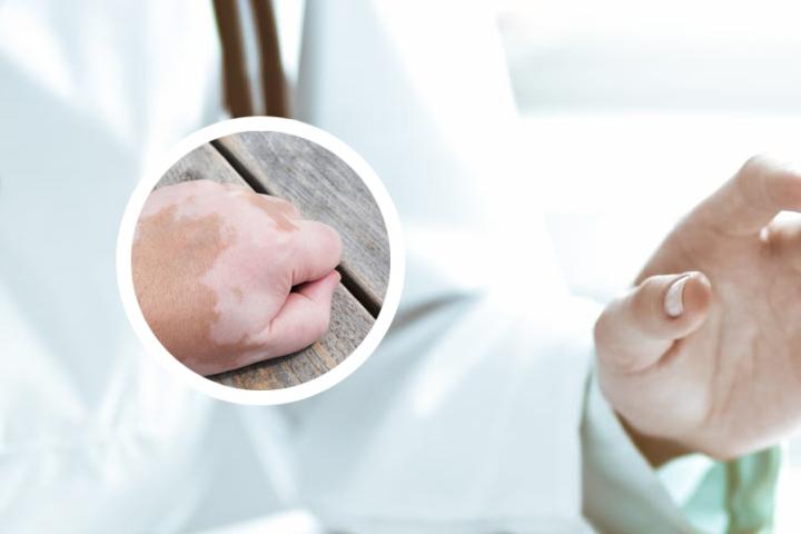 白癜风从哪里发病