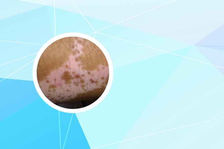 白癜风308激光有水泡