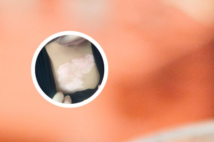 手指白癜风能不能治好