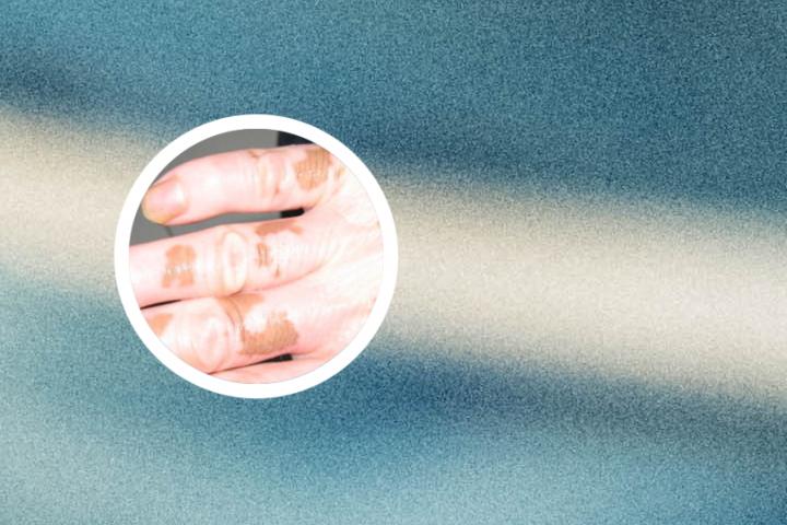 白癜风一定要外用药吗
