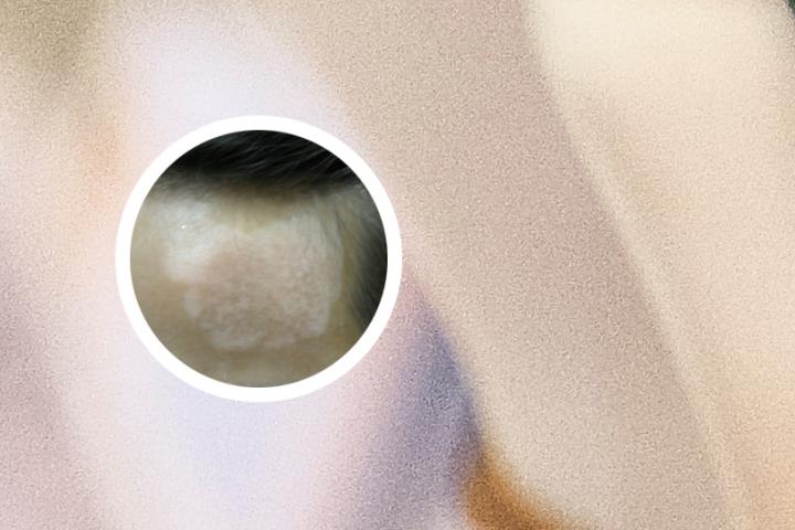 白癜风患者可以结婚生子吗