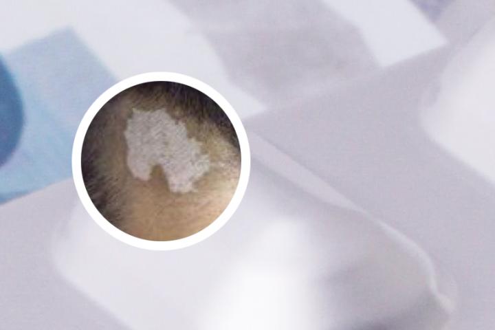 桂林白癜风可以报销吗
