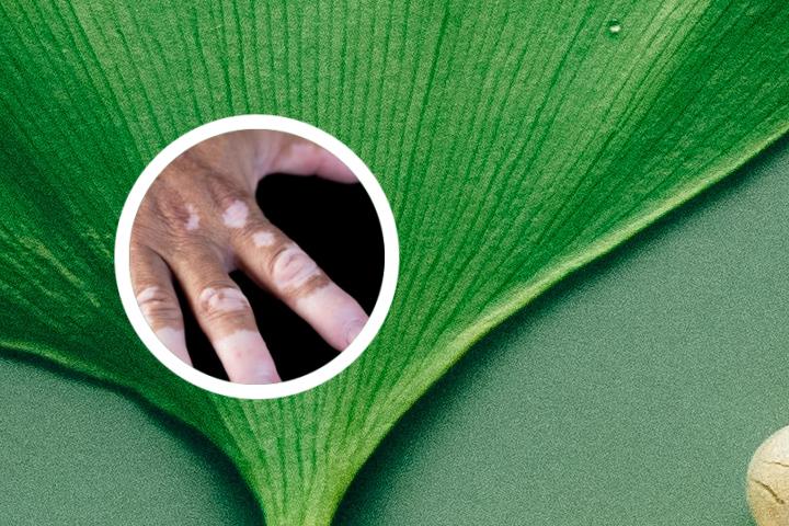 青岛哪里治疗白癜风效果好