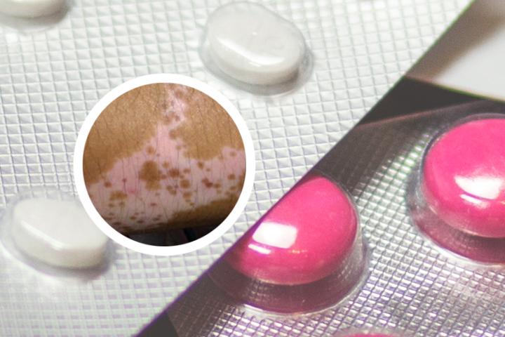 白癜风局部摩擦会发红吗