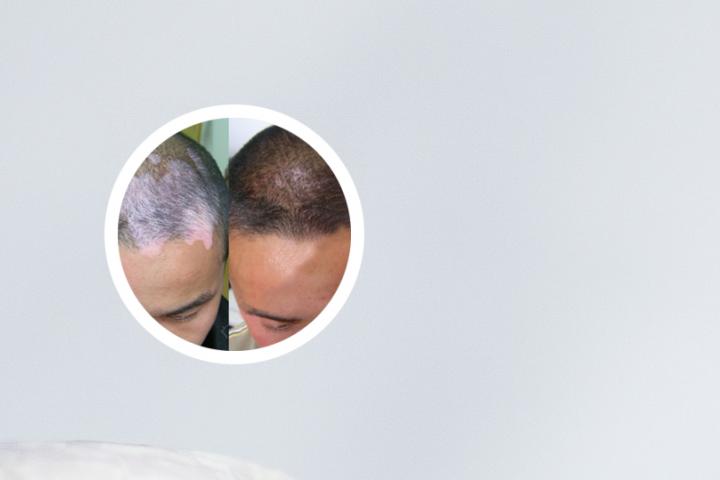 白癜风的诊断依据有哪些