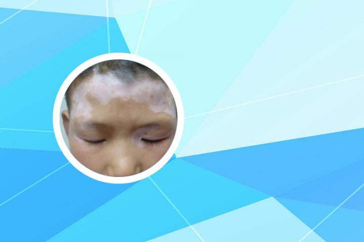 冬天白癜风如何护理