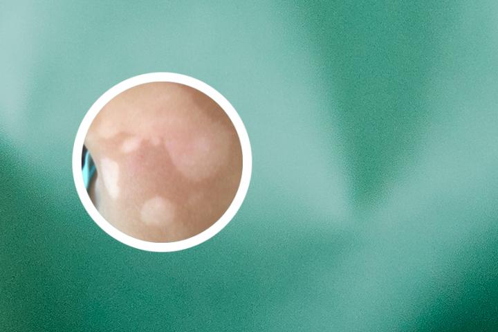 白癜风番茄方便面可以吃