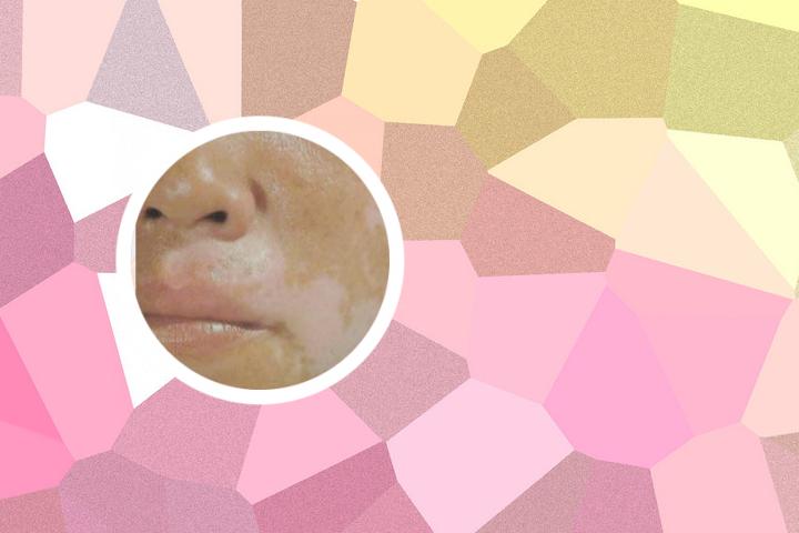 白癜风遗传后代概率