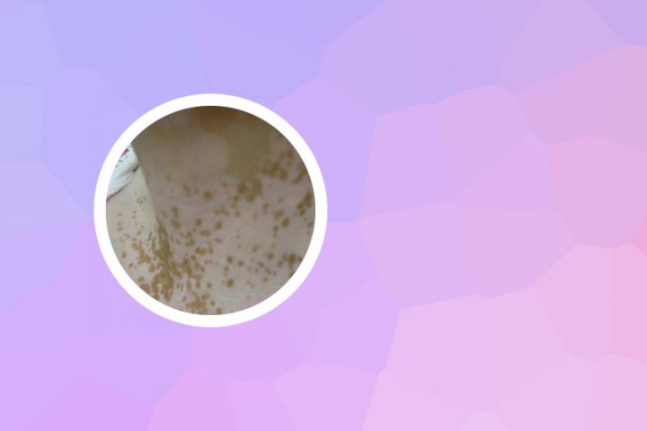 白癜风危及生命吗