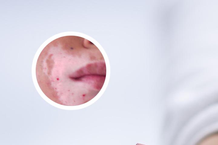 哈尔滨白癜风光疗