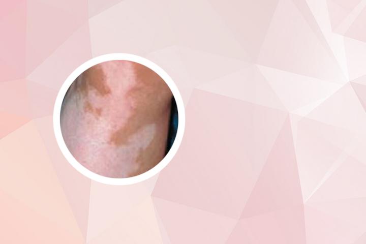 腰上的白癜风怎么治疗