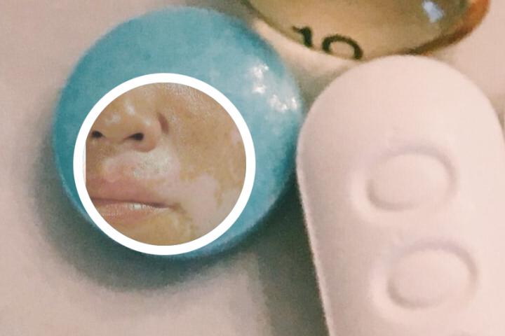 白癜风几种分类图片