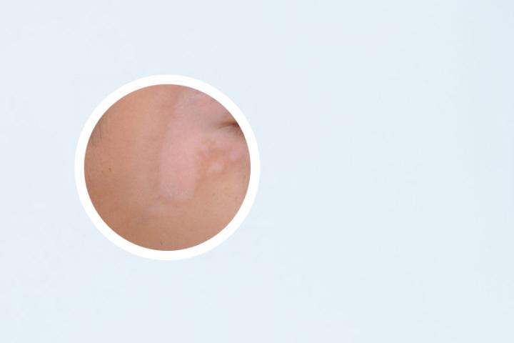 甘肃哪里看白癜风有效