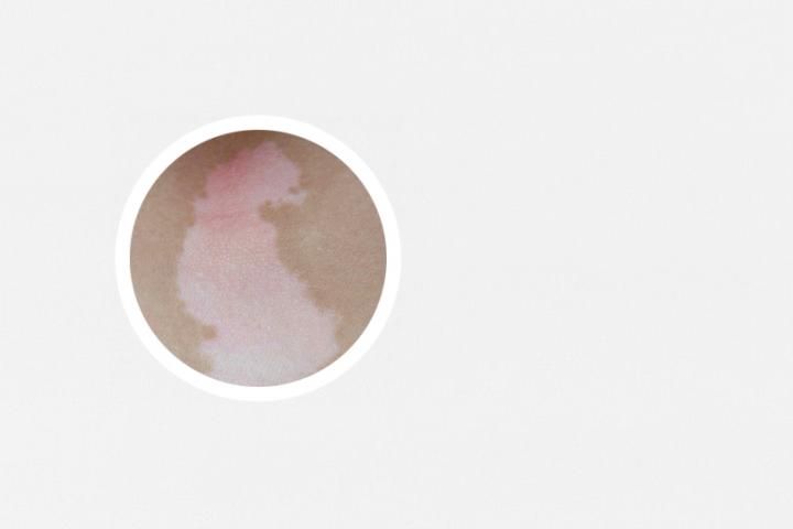 韭菜汁能治疗白癜风了