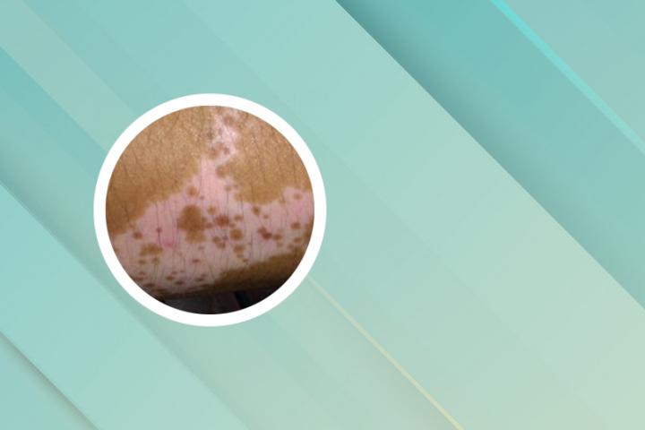 银杏叶片治疗白癜风怎么样