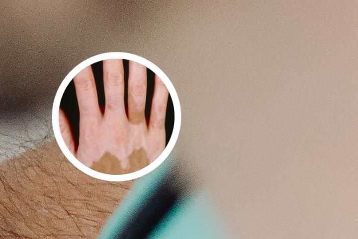 贫血痣被误认为白癜风