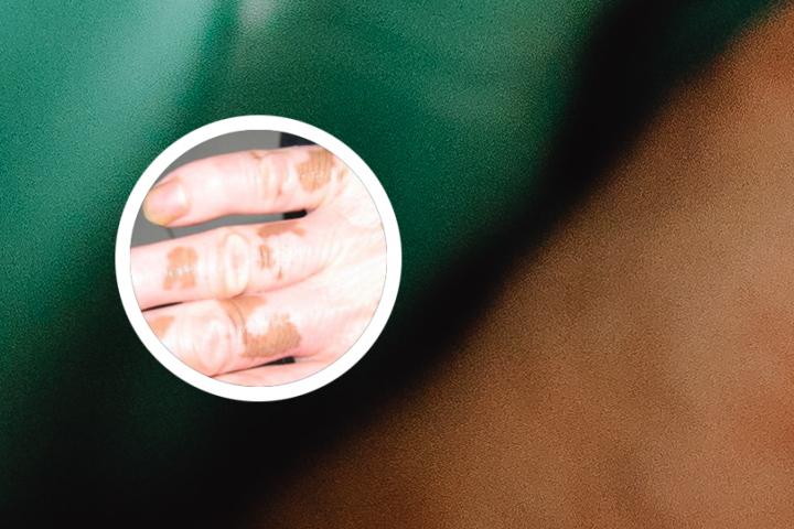 脸上白癜风能不能用红霉素