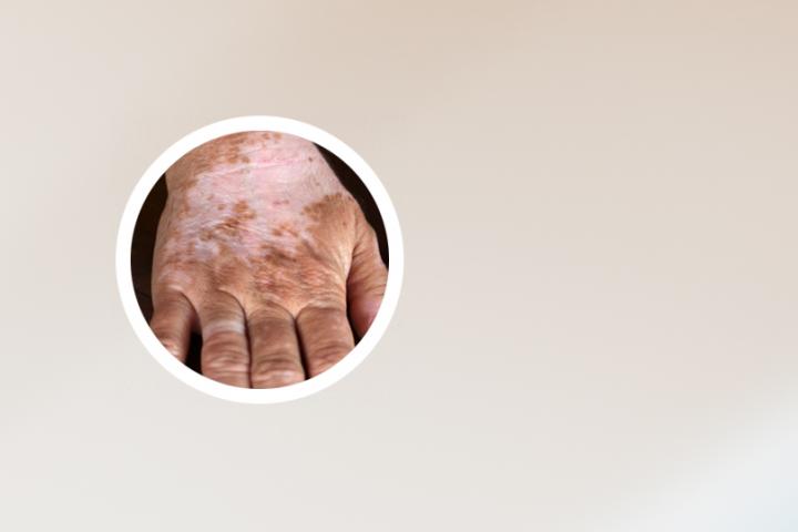 中医专家视频白癜风的诱因