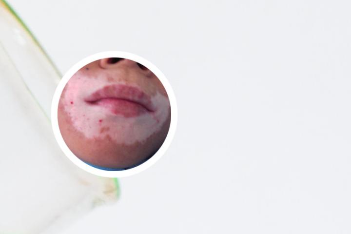 白癜风患者输液可以输维c吗