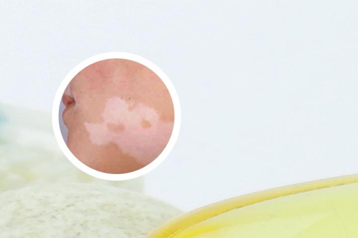 白癜风宝宝能吃哪些水果