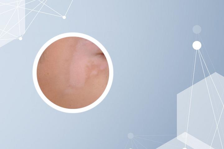 白癜风照308危害