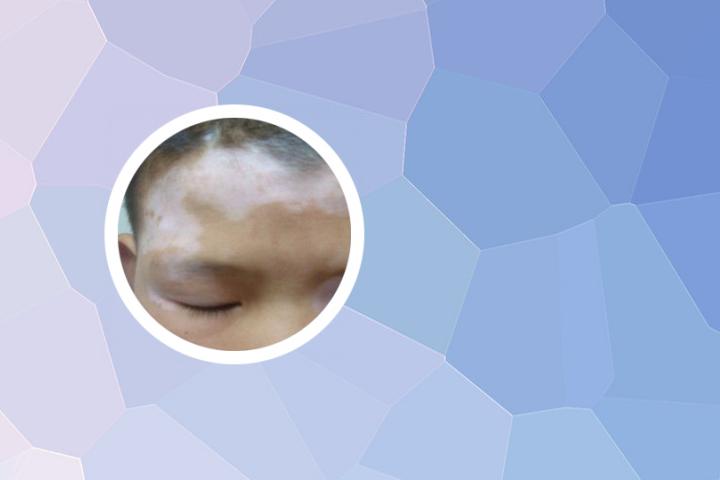 白癜风晚上睡眠不足怎么办