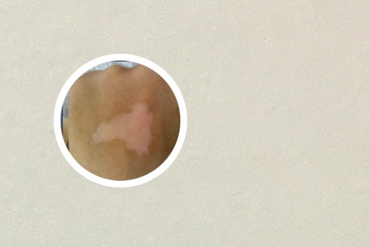 白癜风的皮肤镜检查结果