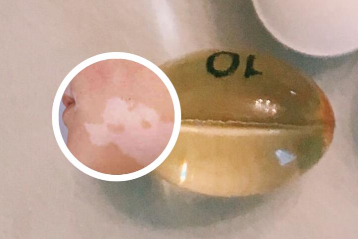 白癜风人可以吃黄瓜吗